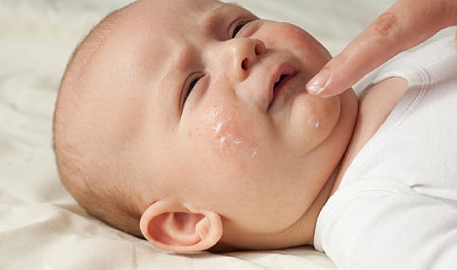 14 Eylül Dünya Atopik Dermatit Günü dolayısıyla Türkiye Ulusal Alerji