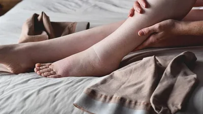 Özellikle kadınları daha fazla etkileyen lipödem obezite ile karıştırılabiliyor. Beslenme