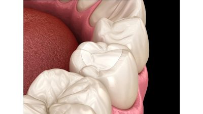 Günümüzde en sık tercih edilen dolgu türleri arasında yer alan