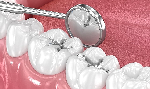 Diş dolgularının temel amacı; çürük nedeniyle zarar gören diş dokusunu